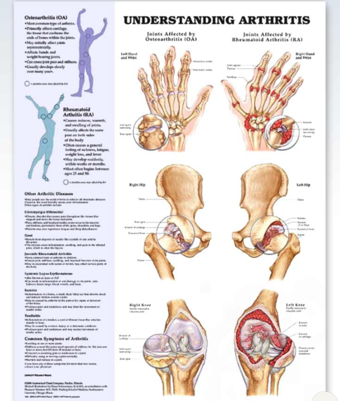 Understanding Arthritis Chart